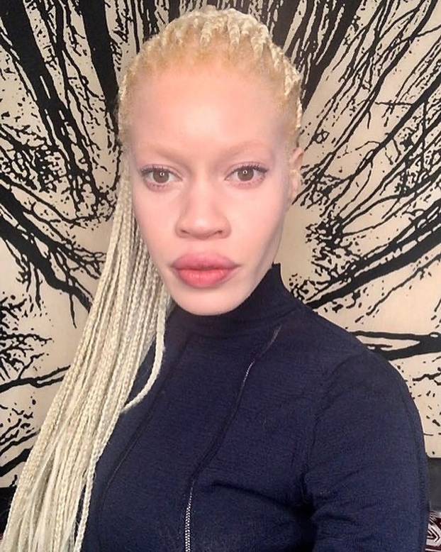 FOTO Afrikanka s albinizmom osvaja modnu industriju: 'Često privlačim znatiželjne poglede'