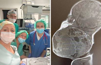 DETALJI ČUDA S REBRA Na pola porodili dijete da izvade tumor. Dio bebe bio je u maternici!