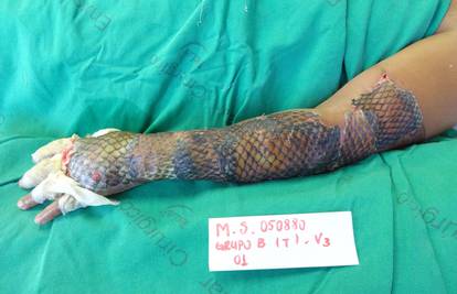 Imala je stravične ozljede: Ženi opekline liječe ribljim ljuskama