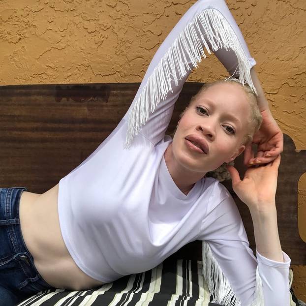 FOTO Afrikanka s albinizmom osvaja modnu industriju: 'Često privlačim znatiželjne poglede'