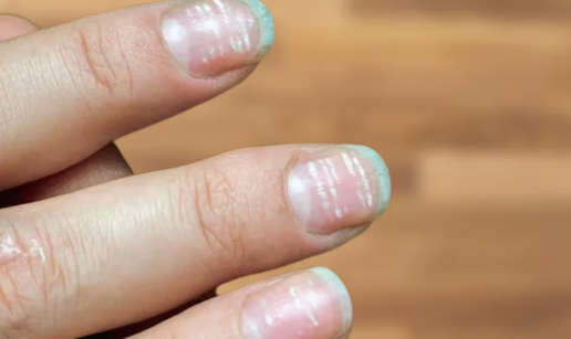 Ovo su promjene na noktima koje ne smijete ignorirati