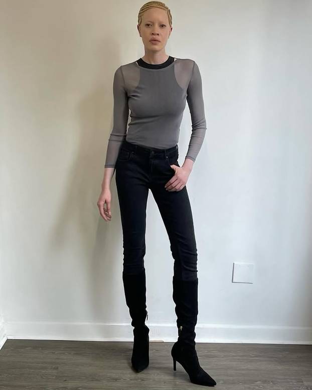 FOTO Afrikanka s albinizmom osvaja modnu industriju: 'Često privlačim znatiželjne poglede'