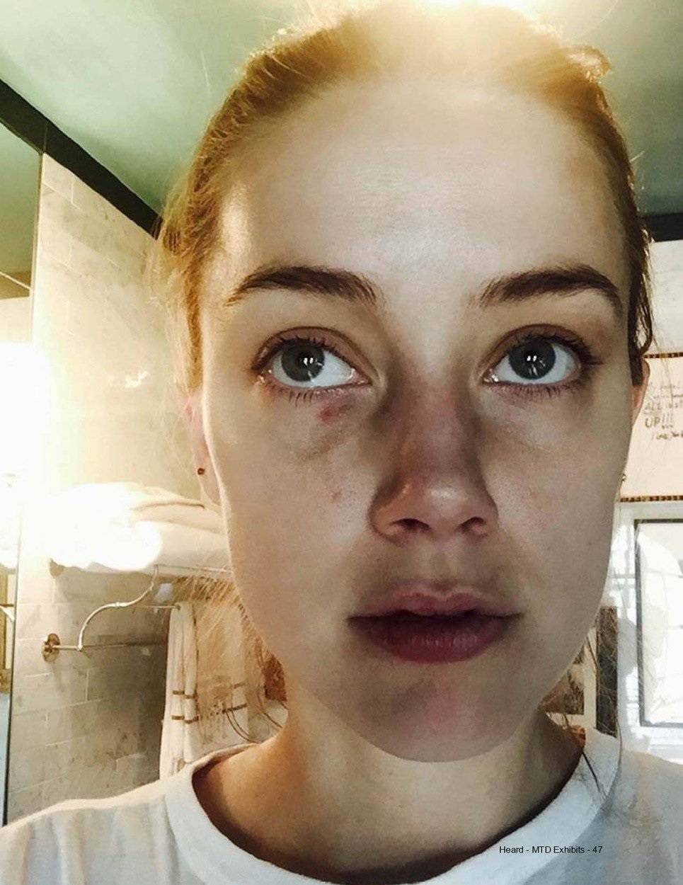 Ill f***ing kill you: Amber Heard pictured with busted lip, facial injuries and clumps of hair missing after telling Johnny Depp she wanted to leave him