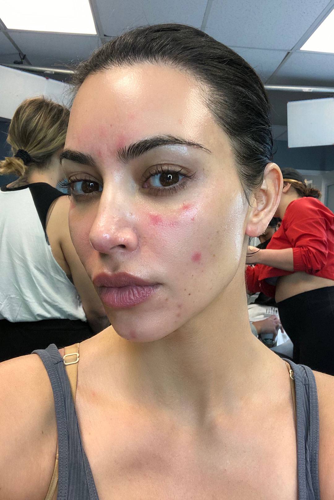 Kim Kardashian progovorila o svojoj borbi s kožnim bolestima