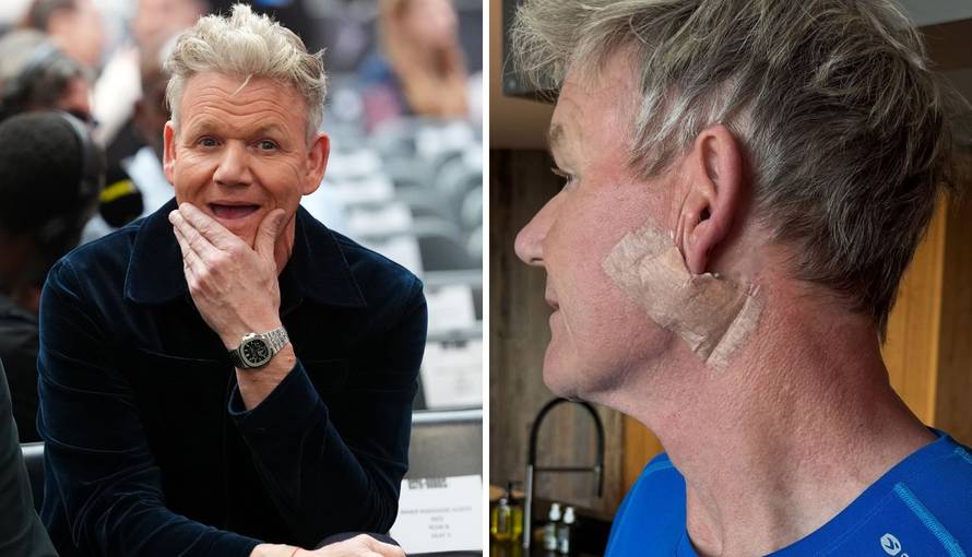Gordon Ramsay podijelio fotke nakon operacije: 'Odstranili su mi karcinom, molim vas, pazite'