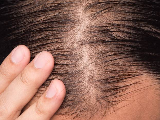 closeup of hair lose