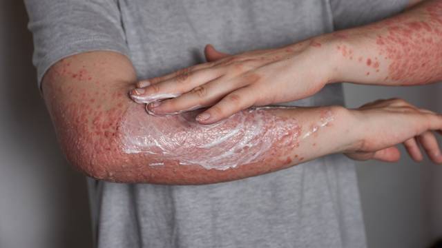 Woman,Applying,Moisturizer,To,Skin,With,Psoriasis,With,Her,Hand