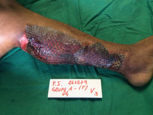 Burns survivor uses fish skin