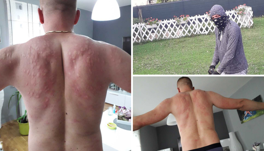 "Ne može se živjeti, pogledajte mi leđa nakon 45 minuta vani"