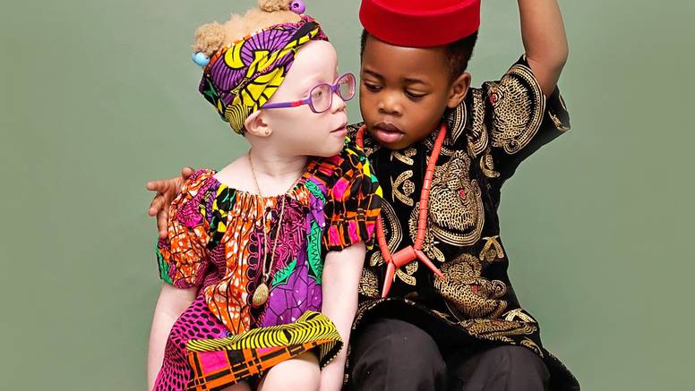 Rodila jedno crno i jedno albino dijete: Mislila je da nije njezino
