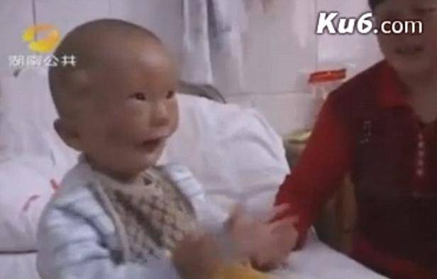 Ima rascjep preko lica: Kineza su prozvali 'dječak s maskom'