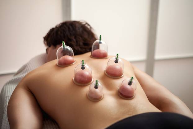 Vacuum,Cups,Therapy,,Wellness,Cupping,Massage,Rehabilitation.,Sporty,Man,Lying
