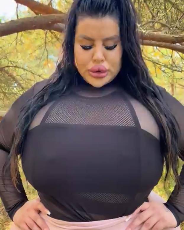 FOTO Stražnjica mi teži 45 kila, no već imam u planu sljedeću operaciju, želim imati najveću!