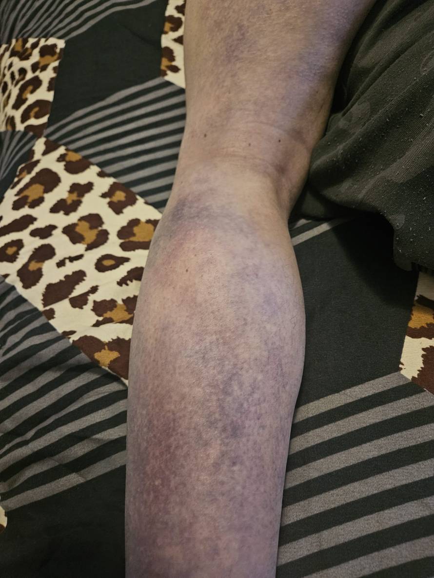 Super Silva za 24sata: Znam tko me napao, bilo je iznenada i s leđa. Jedna noga mi je uništena