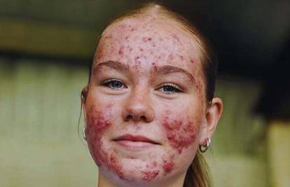 'Sretno, Skye!': Nogometna tinejdžerica postala je meta trolova, ali i simbol podrške