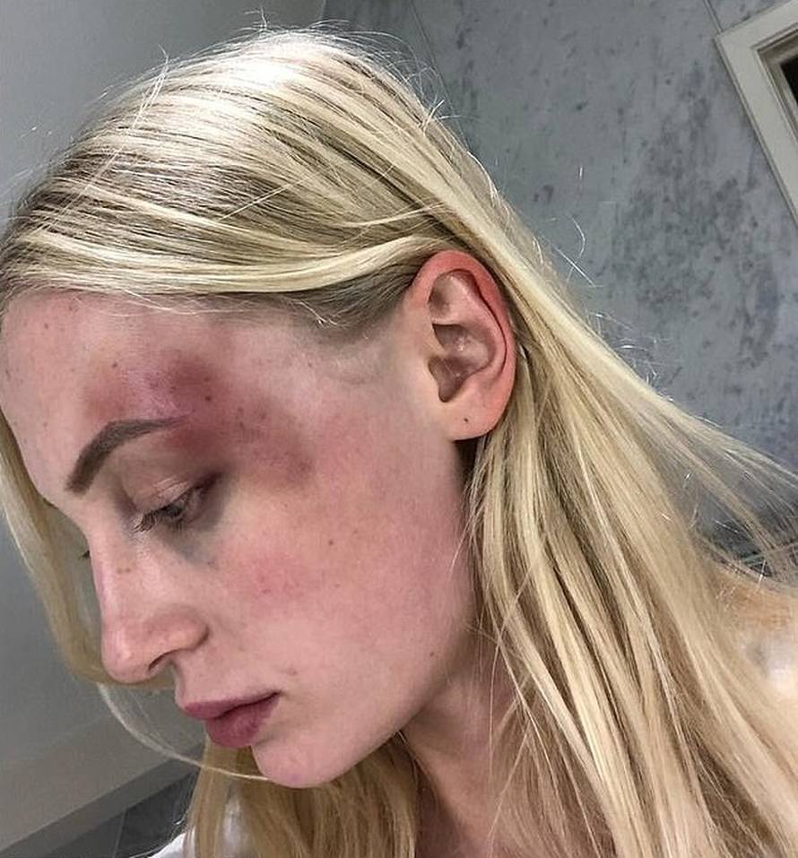 Manekenka je objavila modrice koje joj je nanio dečko: 'Tuga i bol, izlazim jača iz ove veze...'