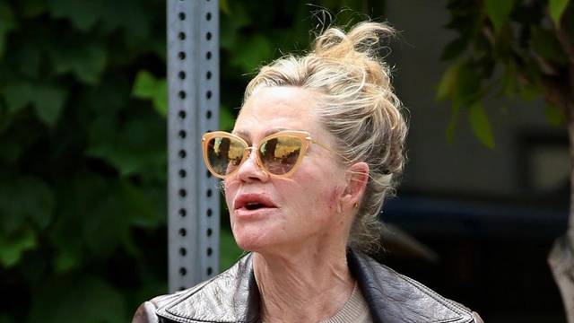*EXCLUSIVE* Melanie Griffith displays a couple of bruises on her face and hands