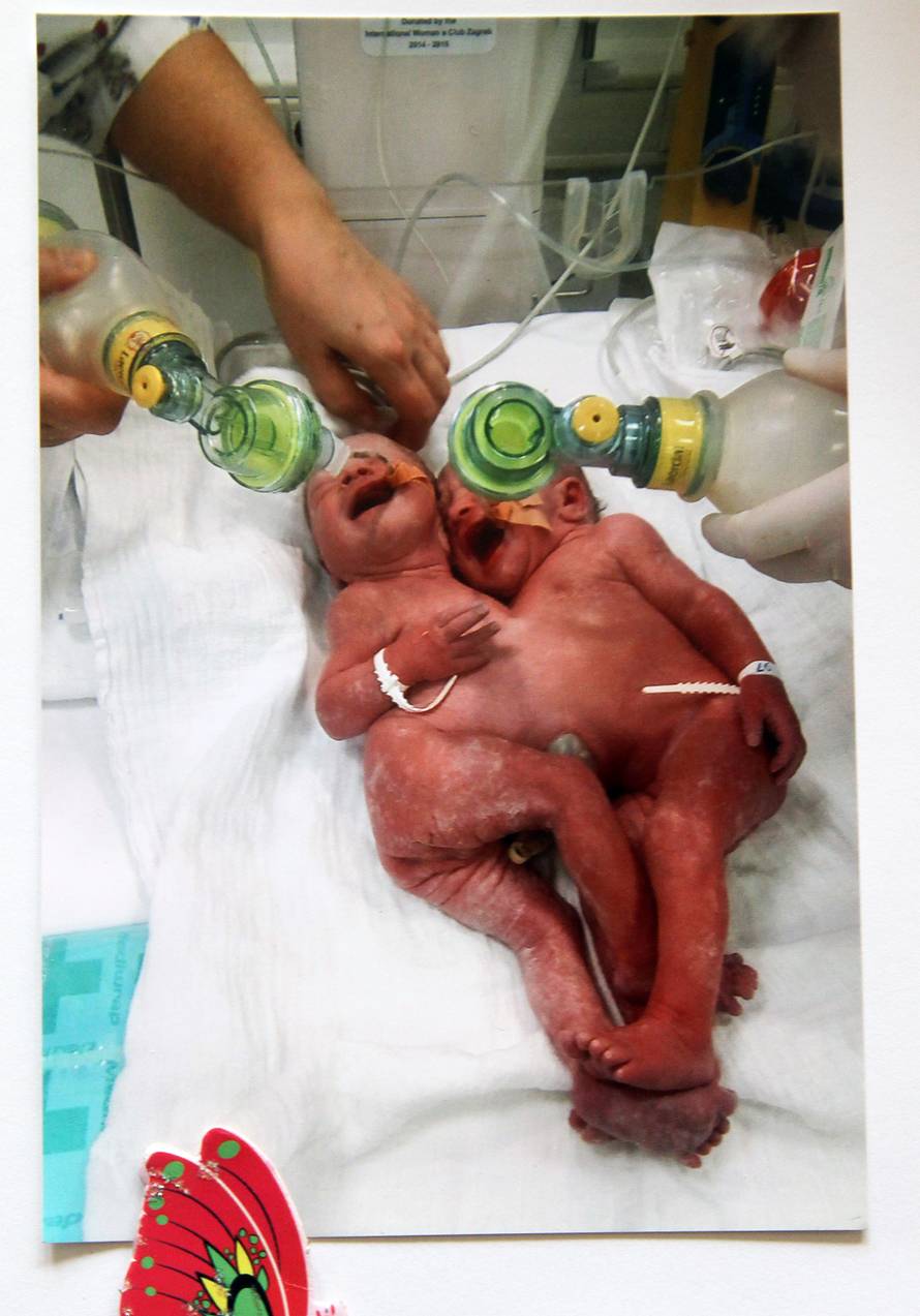 Sijamske blizanke: Seke su bile spojene, imale su zajedničku jetru, a danas su zdrave i vesele