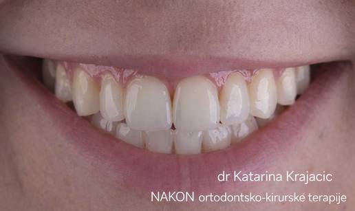 Ortodontsko-kirur&scaron;ka terapija odraslih - Evo &scaron;to trebate znati