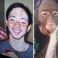 Žena tvrdi da je uspjela vitiligo izliječiti veganskom prehranom