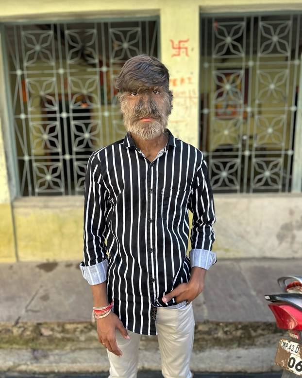 FOTO Ovaj mladić (18) pati od sindroma vukodlaka: U školi me sprdaju, ali volim svoje dlake...