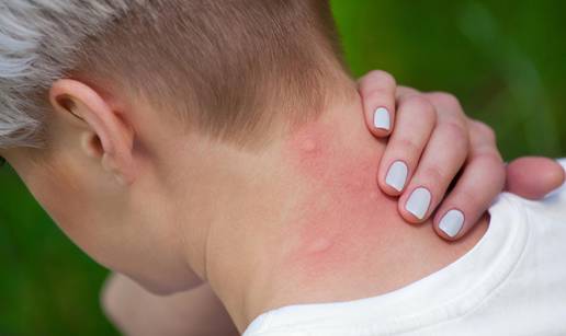 Još nas 'cuclaju': Evo kako lako otjerati komarce i ublažiti svrab