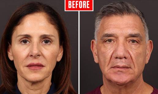 Nakon &scaron;to je vidio rezultate zatezanja lica na svojoj &zcaron;eni i sam se odlu&ccaron;io na isti zahvat