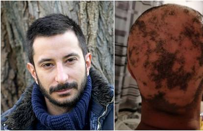 Asim Ugljen o posljedicama alopecije: 'Ovako to izgleda kad vas jako napadne. Nije ugodno'