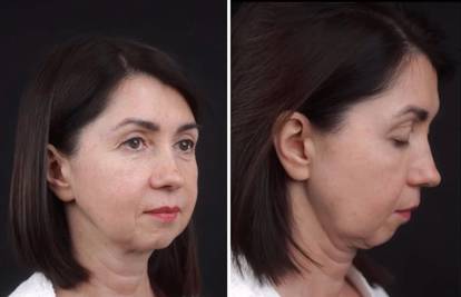 Žena (49) pokazala impresivan rezultat operacije pomlađivanja