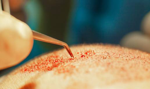 Hrvati ke&scaron;iraju i po 7500 eura za presa&dstrok;ivanje kose, neki se &zcaron;ale na bolne metode...