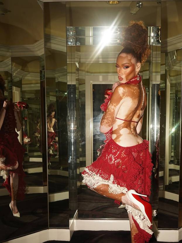 FOTO Rugali su joj se zbog bolesti, a danas je obožavaju zbog jedinstvenog izgleda