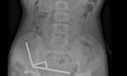 Dječak (13) progutao stotinu magneta koje je kupio online. Oglasili su se s Temua