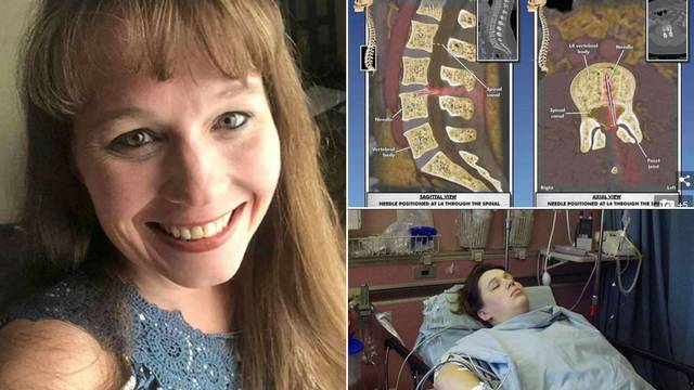 14 godina boli: Ostavili su joj iglu od epiduralne u kralježnici
