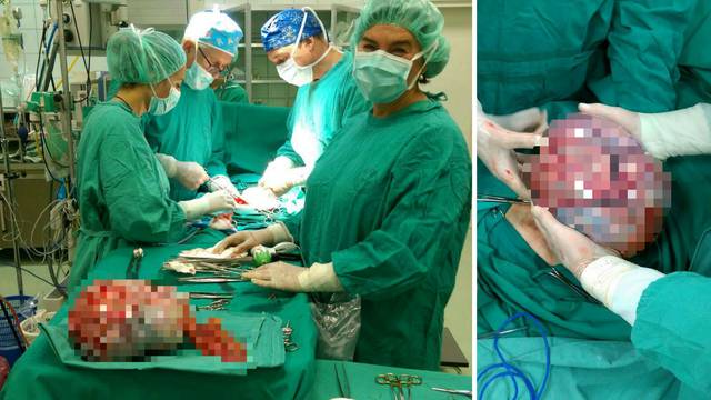 Kirurzi iz Zagrepčanke izvadili tumor: "Bio je velik kao lopta"