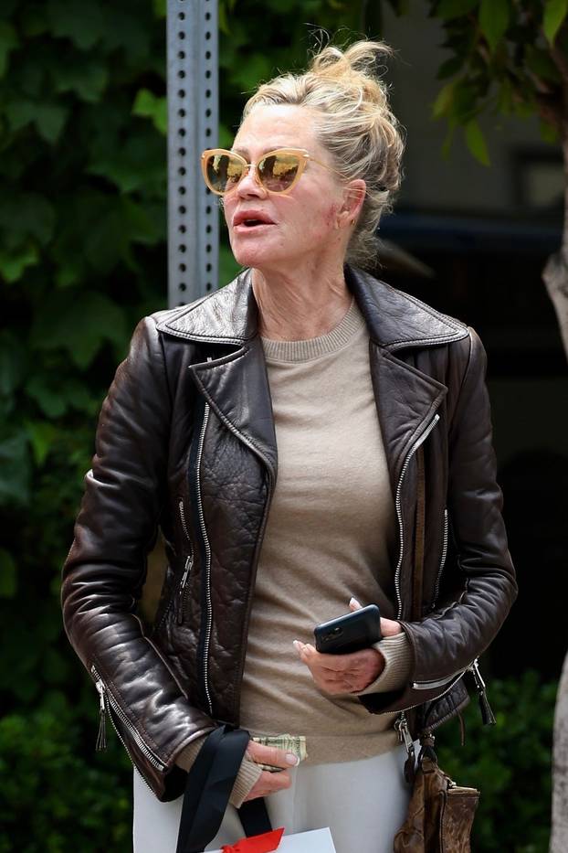 *EXCLUSIVE* Melanie Griffith displays a couple of bruises on her face and hands