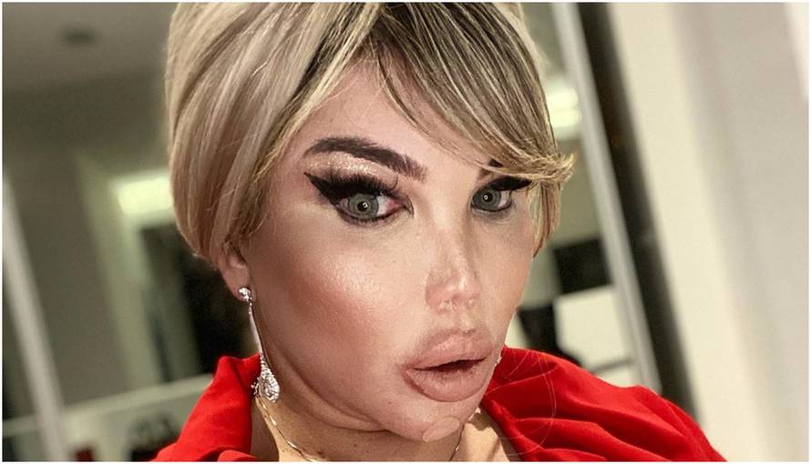 Bivši 'ljudski Ken' objavio fotku bez filtera: 'Što je s liječnicima koji te i dalje pristaju operirati?'