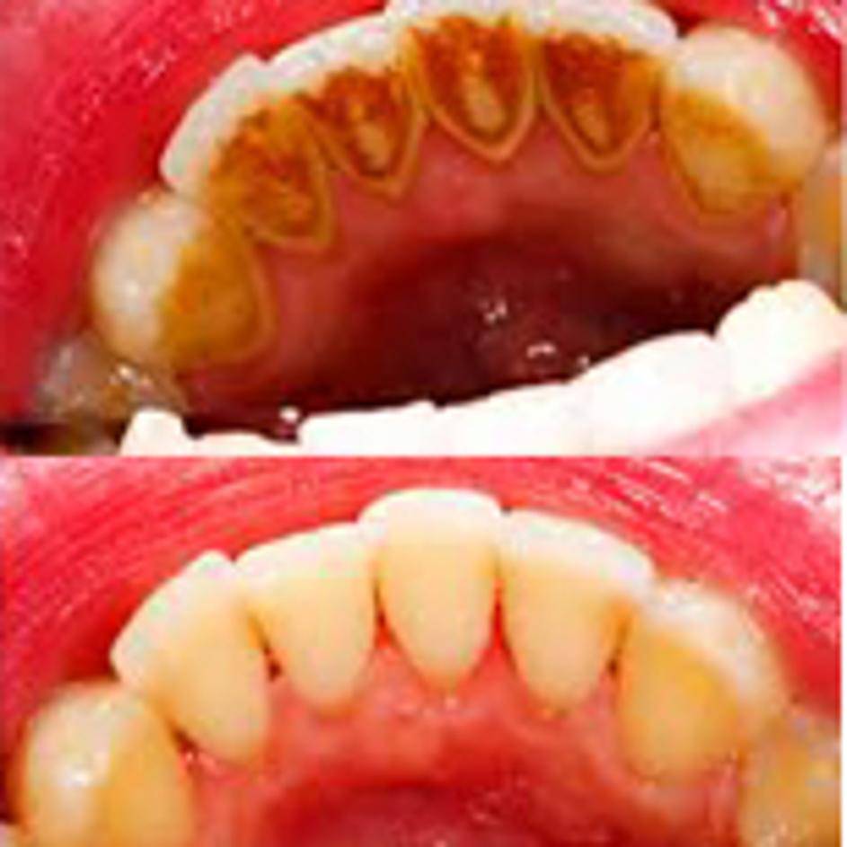 Odstranite zubni kamenac bezbolno u vlastitom domu