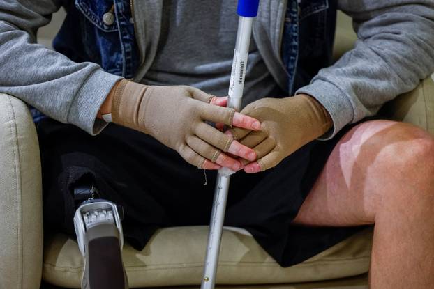 Former Ukrainian serviceman, who was wounded at a front line, comes to a clinic to treat scars, in Kyiv