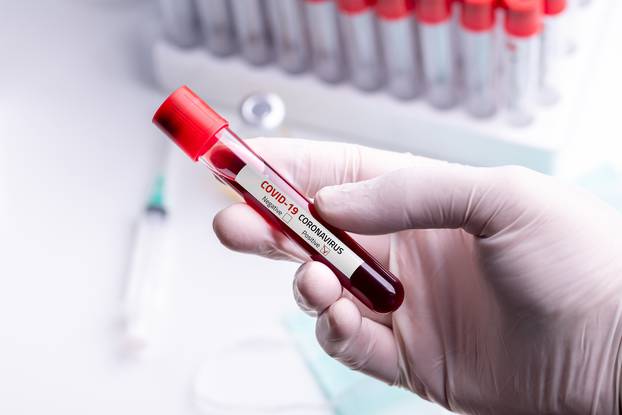 Coronavirus Blood Sample