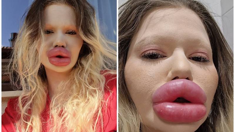 FOTO Žena s najvećim usnama na svijetu otkrila kako je nekoć izgledala: Šok! Bila si prekrasna