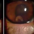 Žalio se na bolove, gubio vid... : Muškarcu u oku pronašli crva
