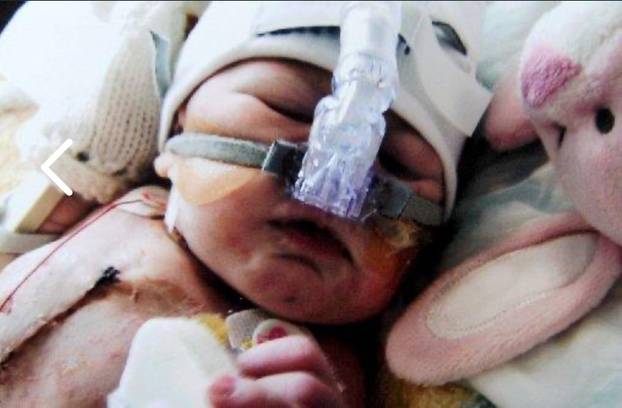 'I survived FIVE open-heart surgeries and stand three inches taller after life-changing spinal operation'