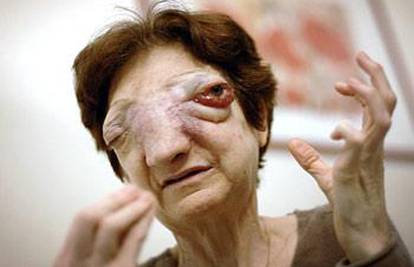 Francuskinja s tumorom na licu nije umrla prirodno