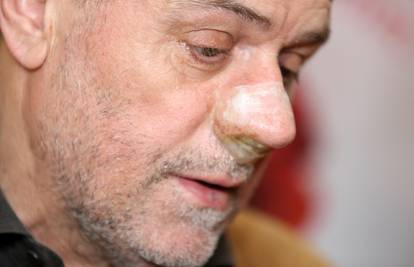 Komplikacije zbog nosa: Milan Bandić hospitaliziran na Rebru