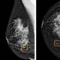 Novi program bolji u dijagnozi raka dojke od samih radiologa