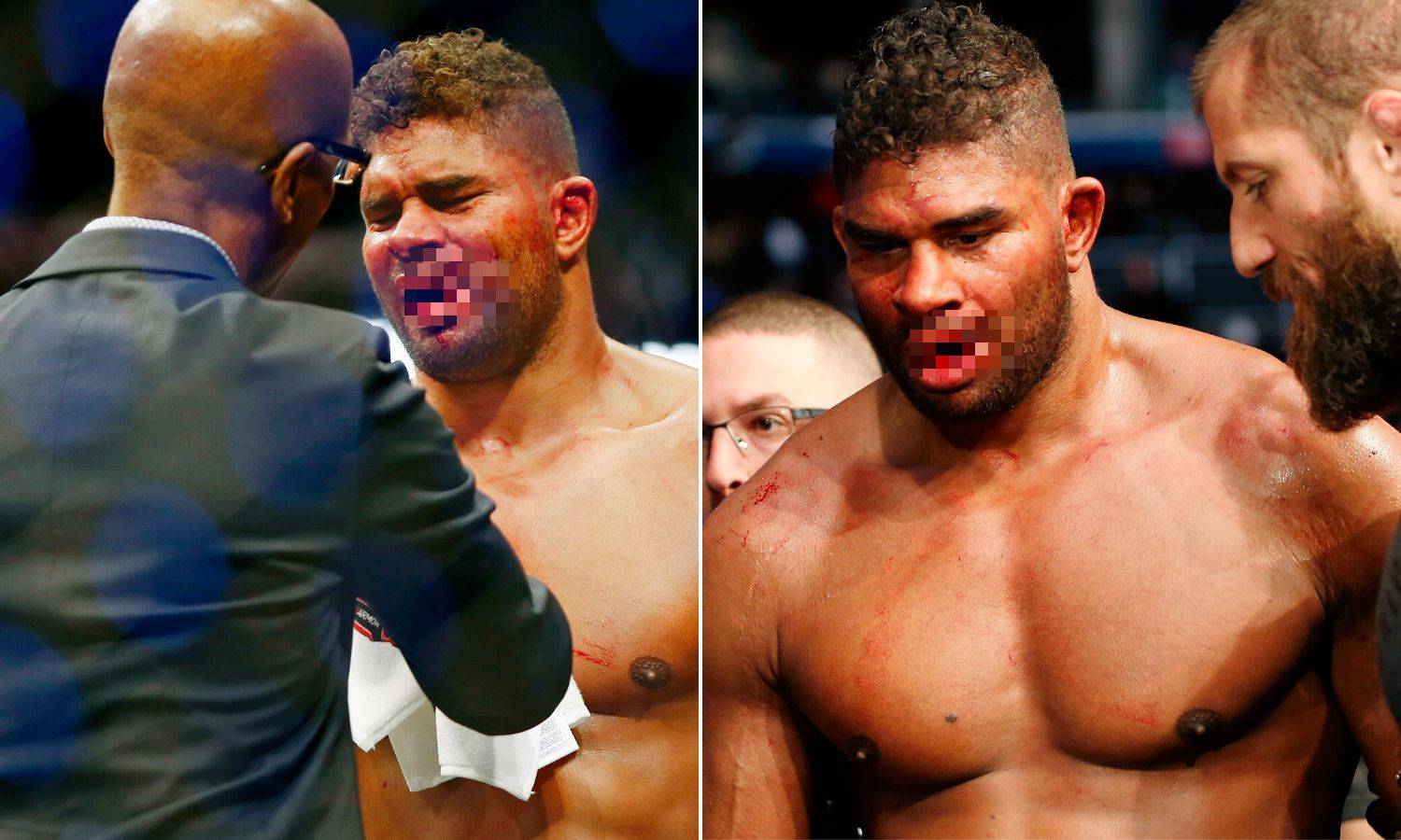 Uznemirujuće! Overeem nakon nokauta ostao bez dijela usne