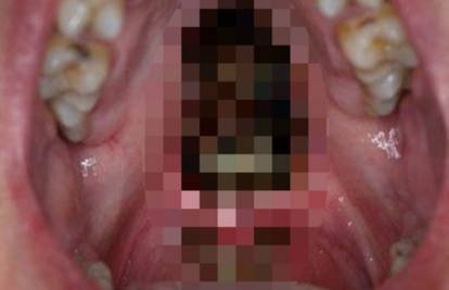 Zubar zaprepastio svijet: Ovo su usta kokainskog ovisnika