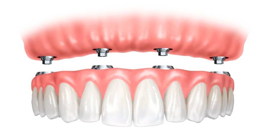 Novi zubi u jednom danu: Kome je rješenje namijenjeno?