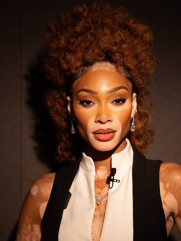 FOTO Rugali su joj se zbog bolesti, a danas je obožavaju zbog jedinstvenog izgleda