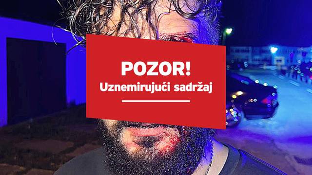 FOTO Novinara iz BiH brutalno pretukao bokserom: 'Došao mi je s leđa. Čekao ga je sivi auto'